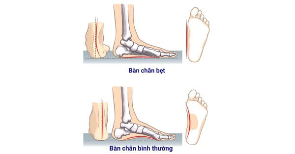 Hướng dẫn cách kiểm tra hội chứng bàn chân bẹt ở trẻ
